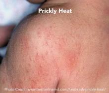 Prickly heat